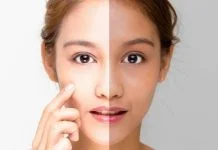 Skin Whitening Treatment Procedure Benefits and Cost