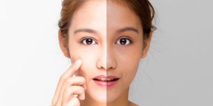 Skin-Whitening-Treatment-Cost-Delhi Cost of Skin Whitening Treatment in Delhi