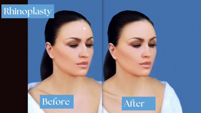 Best Rhinoplasty Surgeon in Delhi, Nose Surgery Cost in Delhi, Plastic Surgeon for Rhinoplasty in Delhi