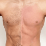 full body laser hair removal in delhi